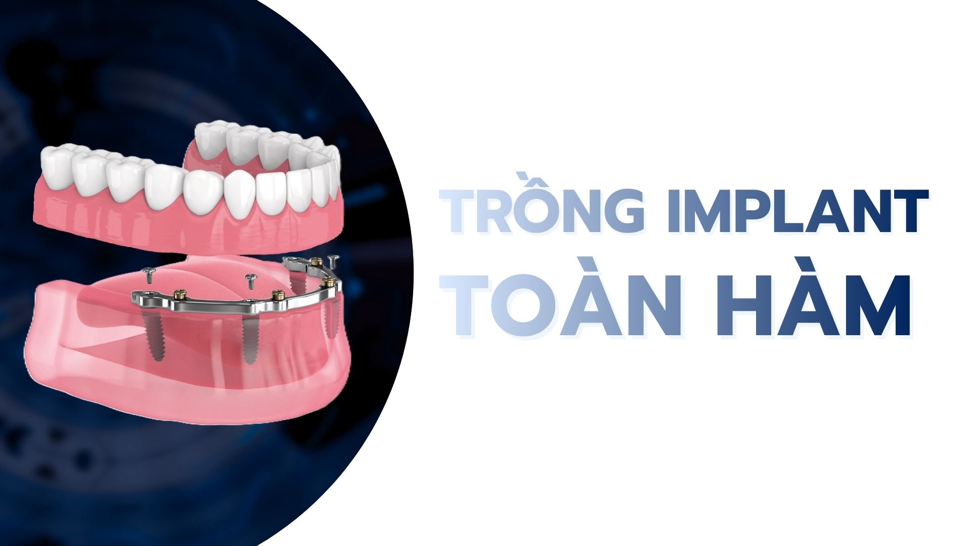 Trồng răng implant toàn hàm