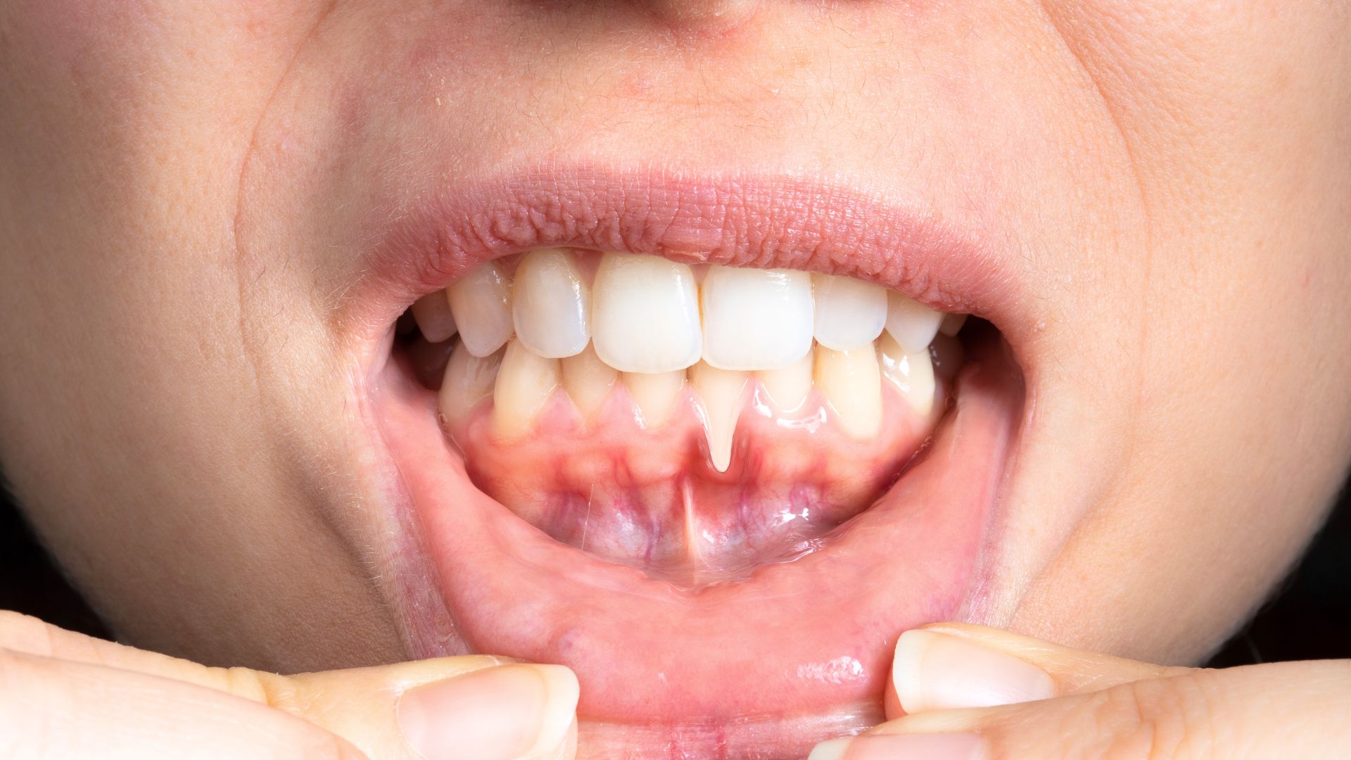 Viêm nha chu_ Tụt nướu, tiêu xương, răng lung lay. Periodontitis_ Receding gums, bone loss, loose teeth