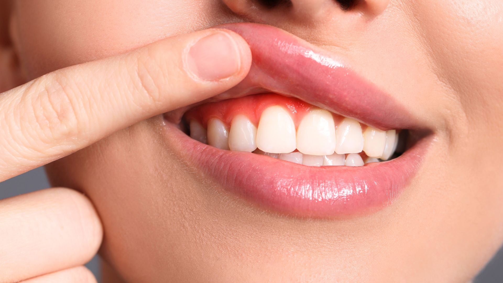 Viêm nướu_ Sưng đỏ, dễ chảy máu khi đánh răng. Gingivitis_ Redness and swelling, easy bleeding when brushing teeth