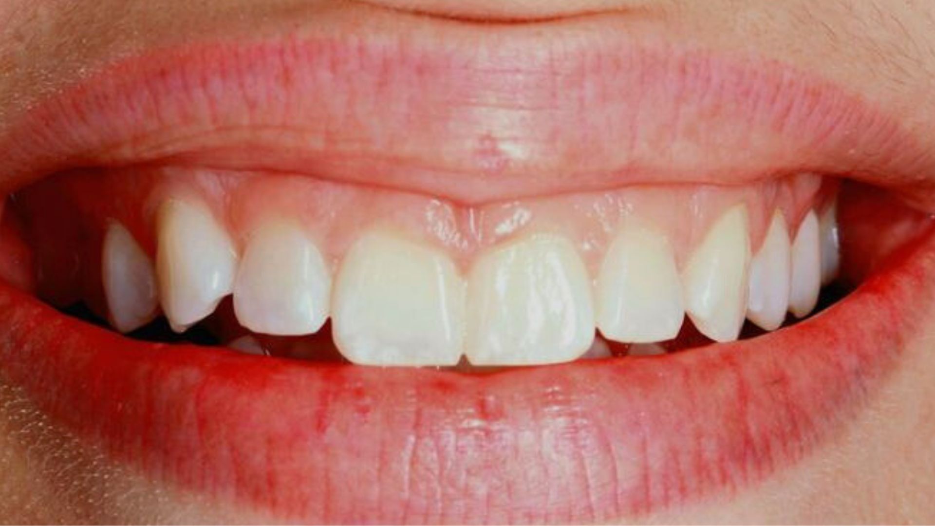 Viền nướu không đều_ Mất cân đối các răng, ảnh hưởng thẩm mỹ Uneven gum line_ Teeth imbalance, affecting aesthetics