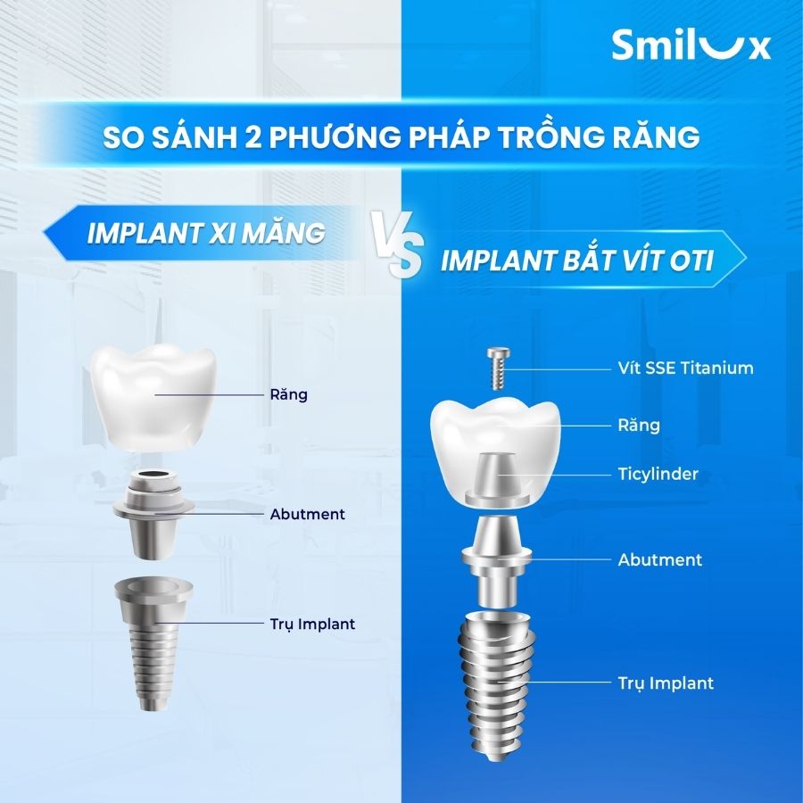 công nghệ trồng răng implant bắt vít định vị OTI không rạch lợi độc quyền tại Smilux