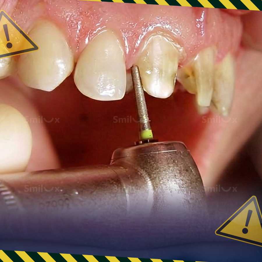5 nguy hiểm trồng răng sứ nếu không chọn công nghệ BioUltra 5 dangers of dental crown placement if you don't choose BioUltra technology.