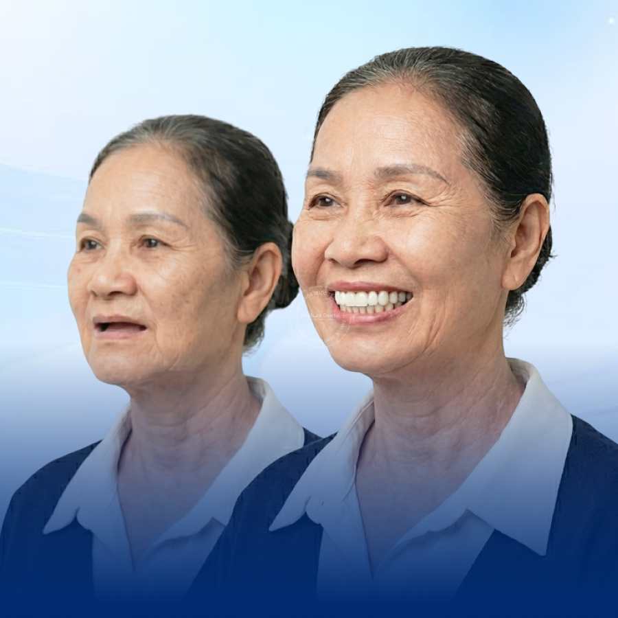 Ai phù hợp với phương pháp trồng răng Implant toàn hàm Who is suitable for full mouth dental implant method