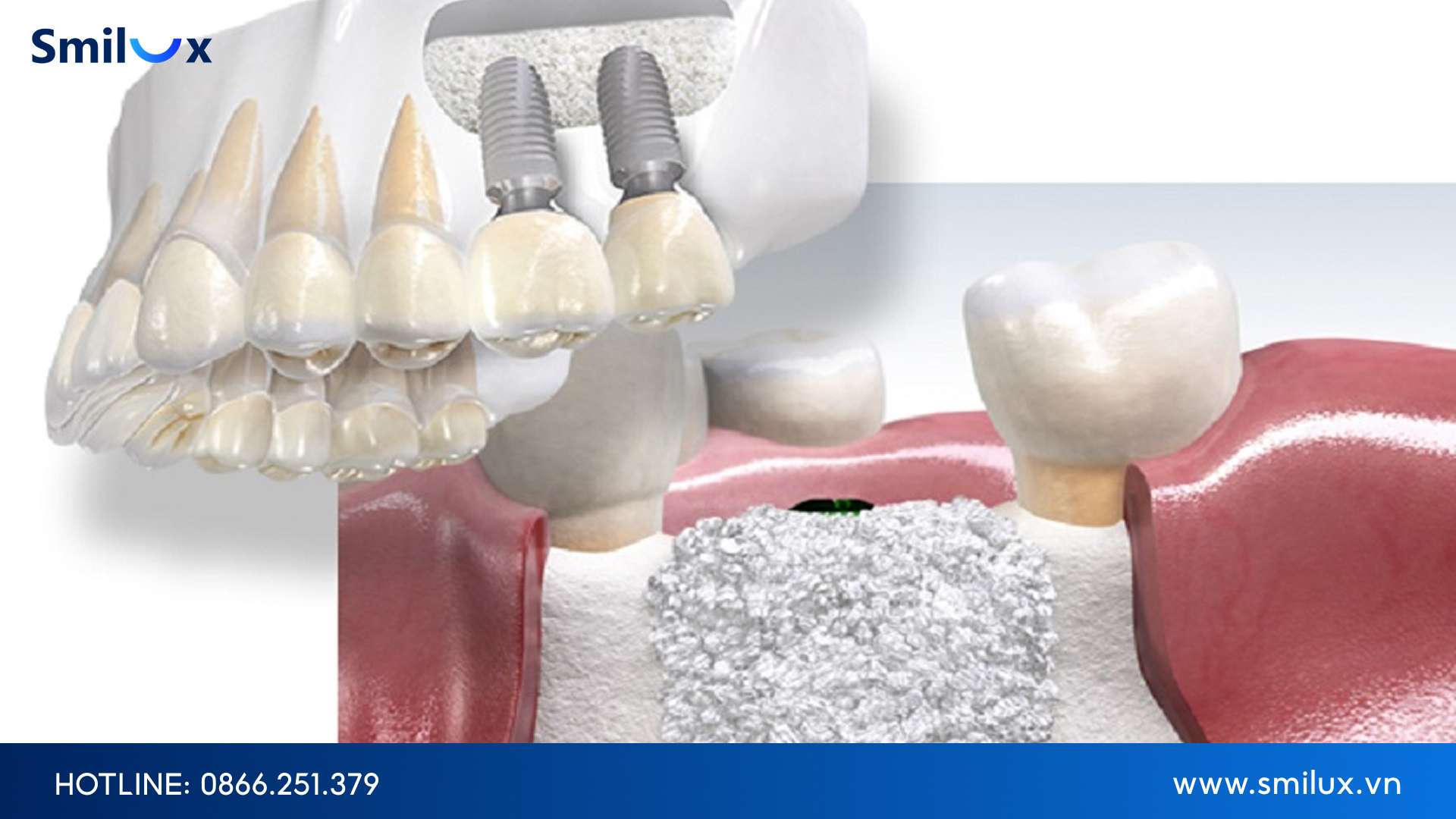 Các yếu tố ảnh hưởng đến thời điểm cấy Implant Factors affecting the timing of dental implant placement