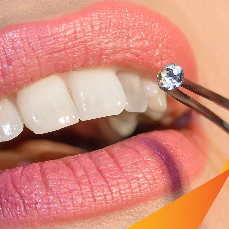 Đính đá lên răng có bền không, bao lâu bị rớt How durable are teeth rhinestones, and how long do they last before falling off