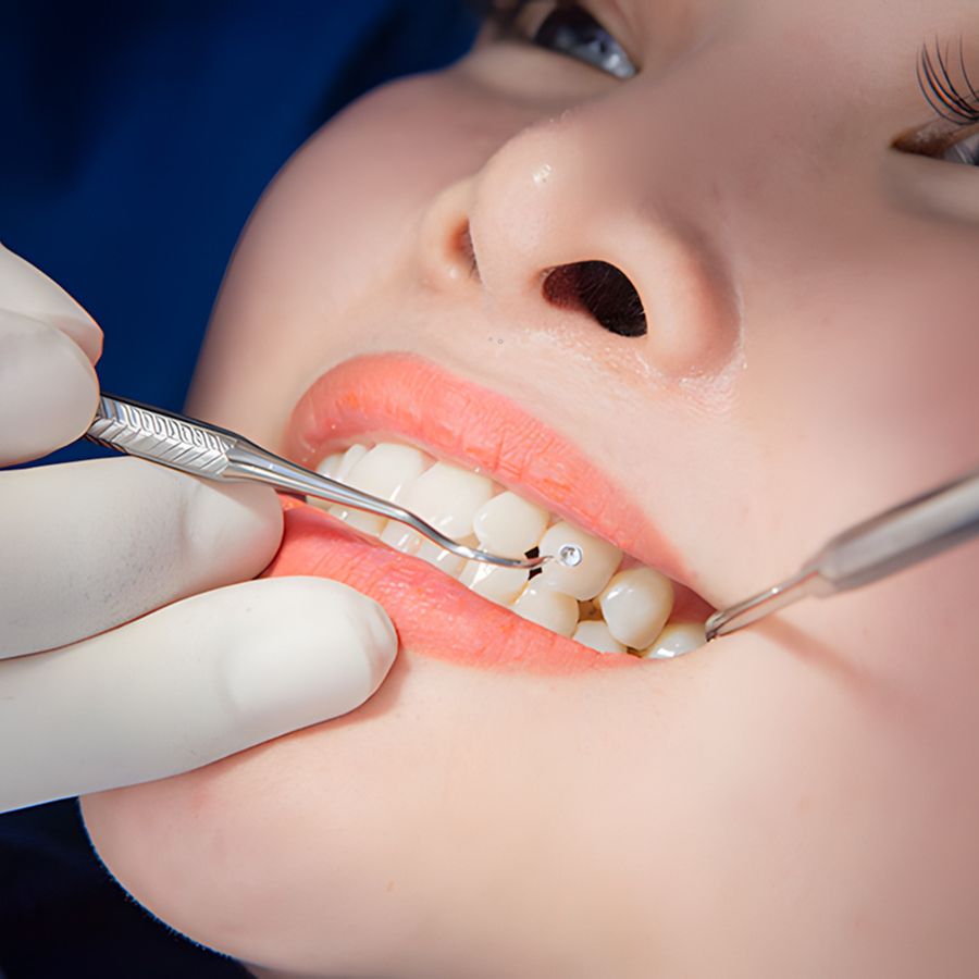 Đính đá răng có cần khoan răng không