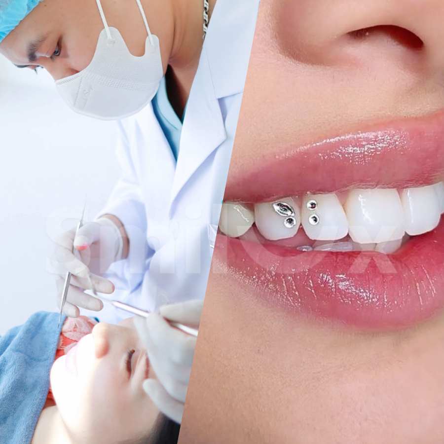 Đính đá răng nên làm ở đâu đẹp và an toàn Where is the best and safest place to get dental rhinestones applied
