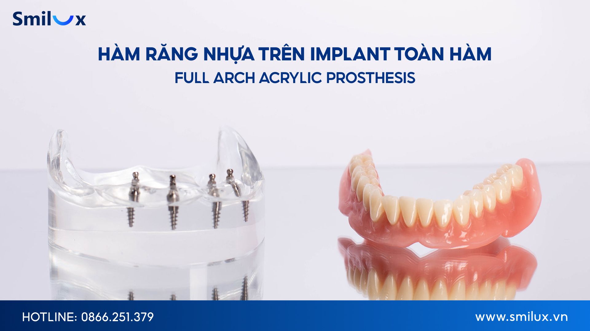 Khi nào nên chọn hàm răng nhựa trên Implant toàn hàm When to choose plastic dentures over full-mouth implants