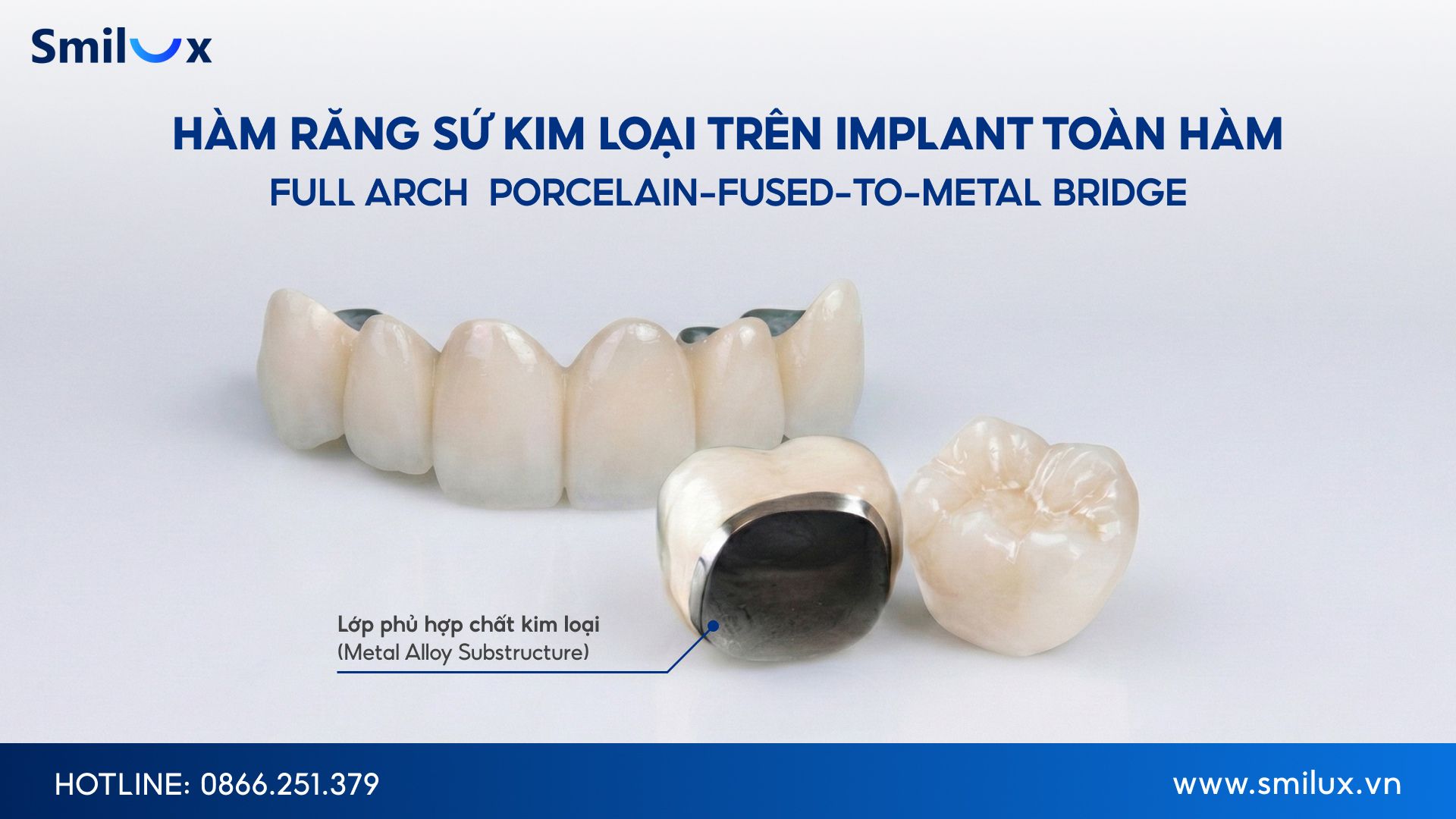 Khi nào nên chọn hàm răng sứ kim loại trên Implant toàn hàm When should you choose metal ceramic crowns over full-mouth implants