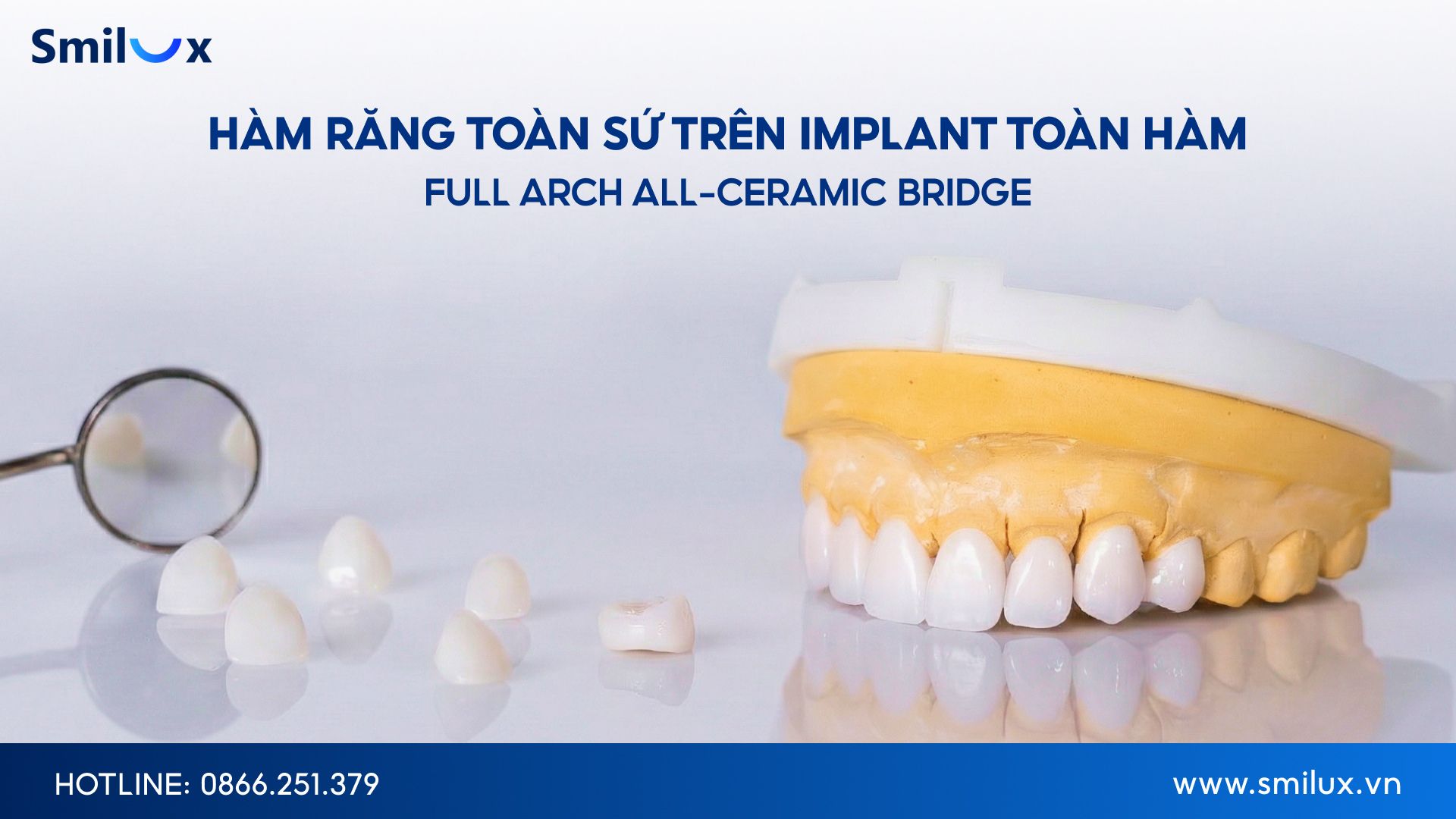 Khi nào nên chọn hàm răng toàn sứ trên Implant toàn hàm When should you choose all-ceramic crowns over full-mouth implants