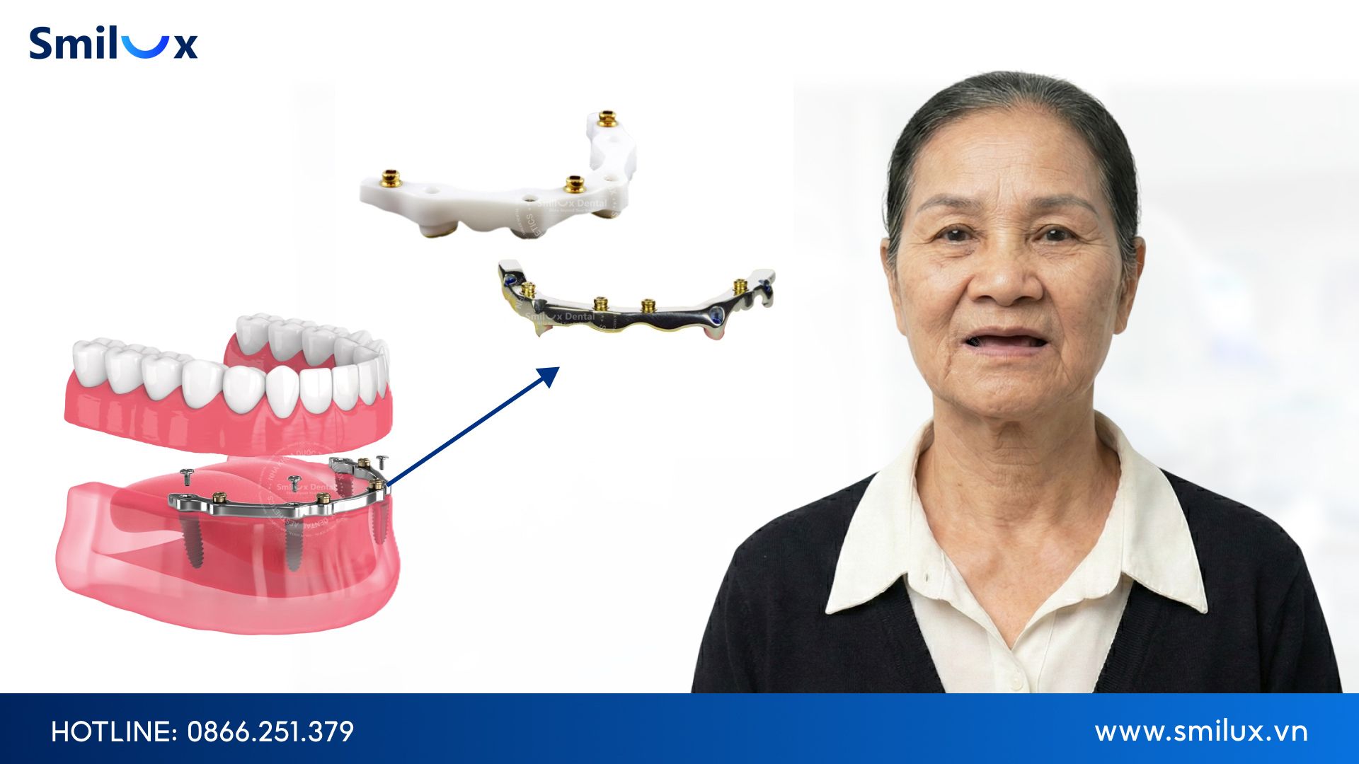 Khi nào nên phục hình bằng kỹ thuật thanh bar When should bar technique be used for restoration