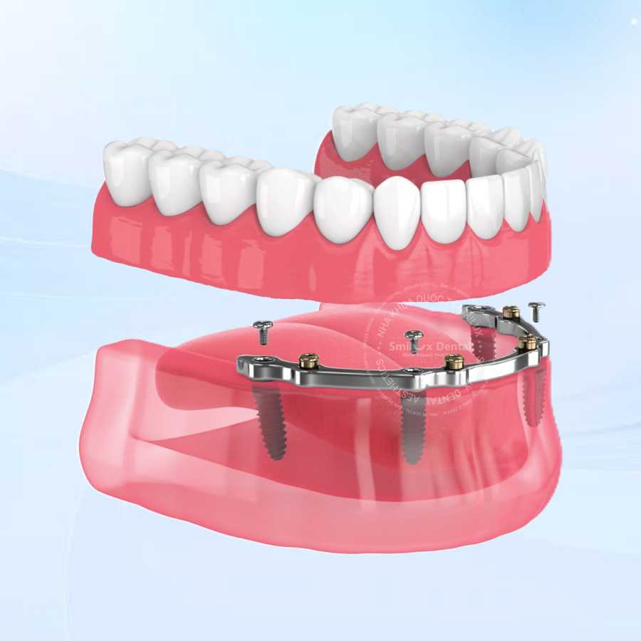 Kỹ thuật Thanh Bar trong trồng răng Implant toàn hàm Thanh Bar technique in full-mouth implant dentistry