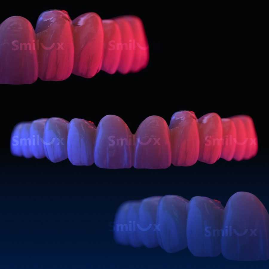Nên chọn răng sứ công nghệ BioUltra hay là răng sứ thông thường Should you choose BioUltra dental crowns or regular dental crowns
