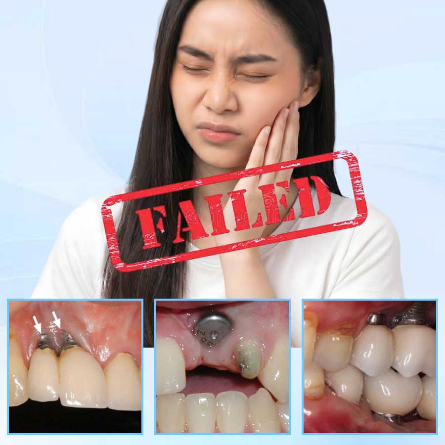 _Những rủi ro có thể gặp khi trồng răng Implant toàn hàm What are the risks of full mouth dental implants