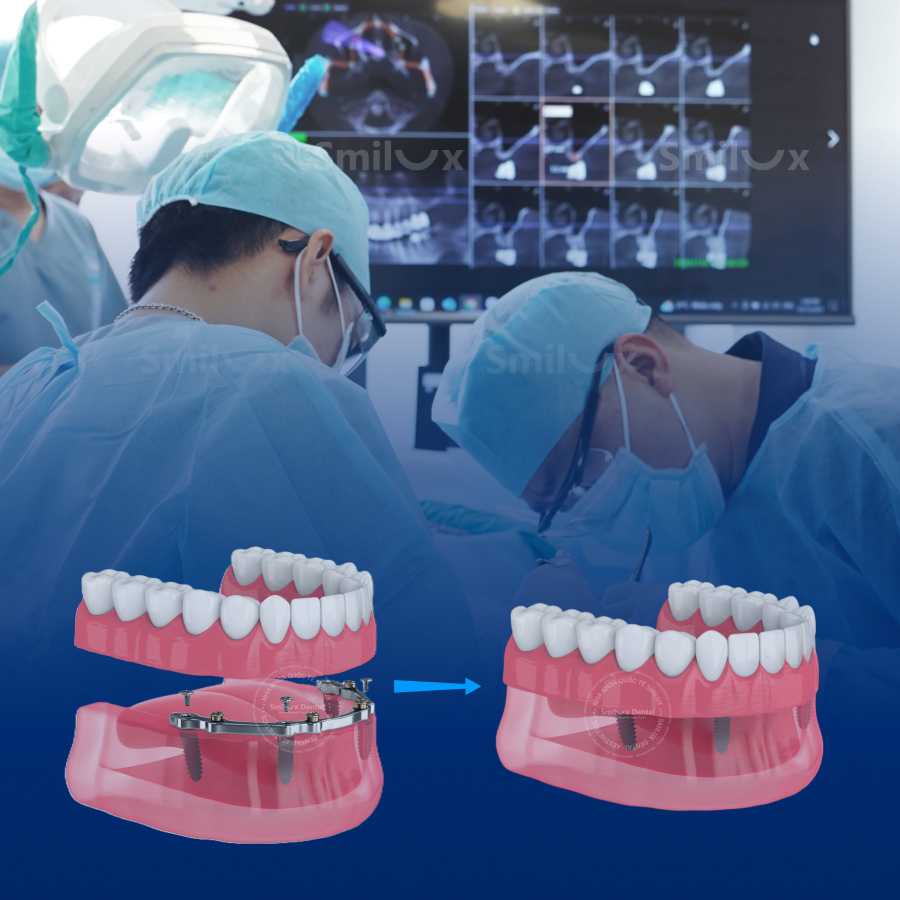 Quy trình trồng răng toàn hàm (All on 4, All on 6) tại Smilux Full mouth dental implant procedure (All on 4, All on 6) at Smilux