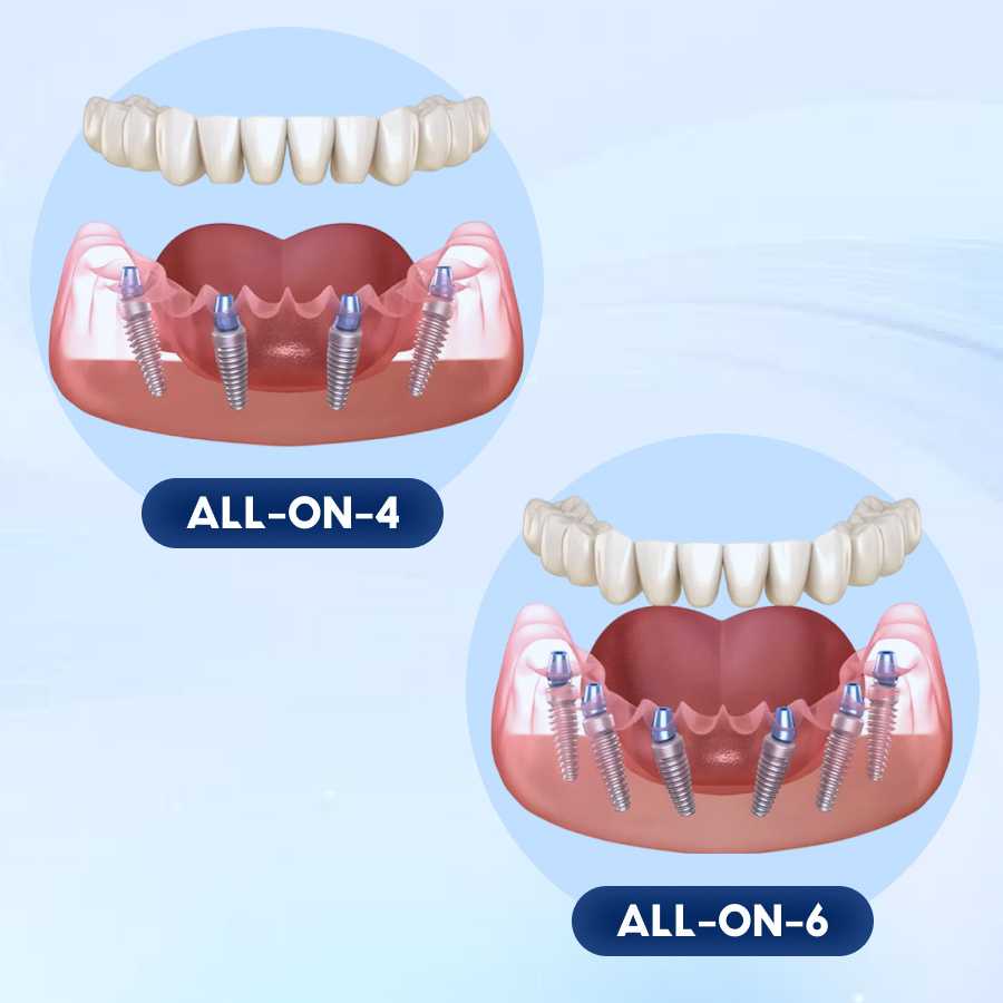 So sánh trồng răng implant toàn hàm 4 trụ và 6 trụ, nên chọn phương pháp nào Comparing all on 4 and all on 6 full-mouth dental implants, which method should you choose
