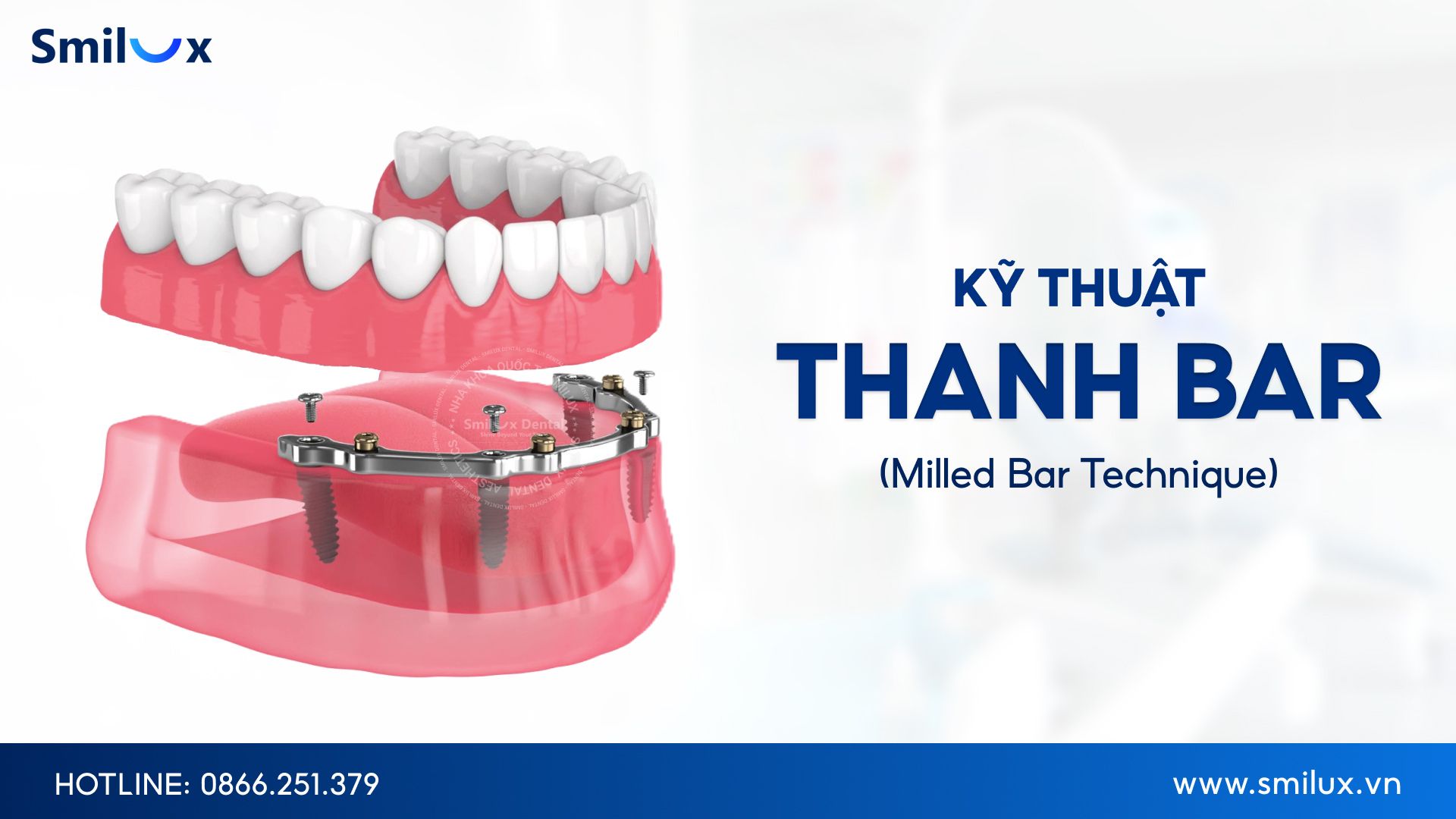 Thanh bar đóng vai trò như khung nâng đỡ giúp hàm răng vững chắc trong implant toàn hàm The bar acts as a support frame to help stabilize the teeth in full-arch implants