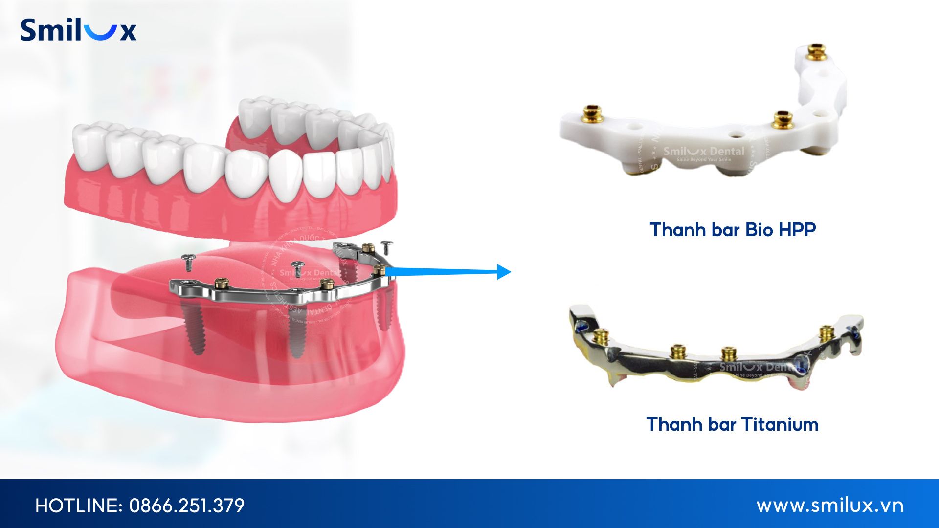 Thanh bar với công dụng nâng đỡ và tản đều lực nhai trên implant Bar with the function of supporting and evenly distributing chewing force on the implant