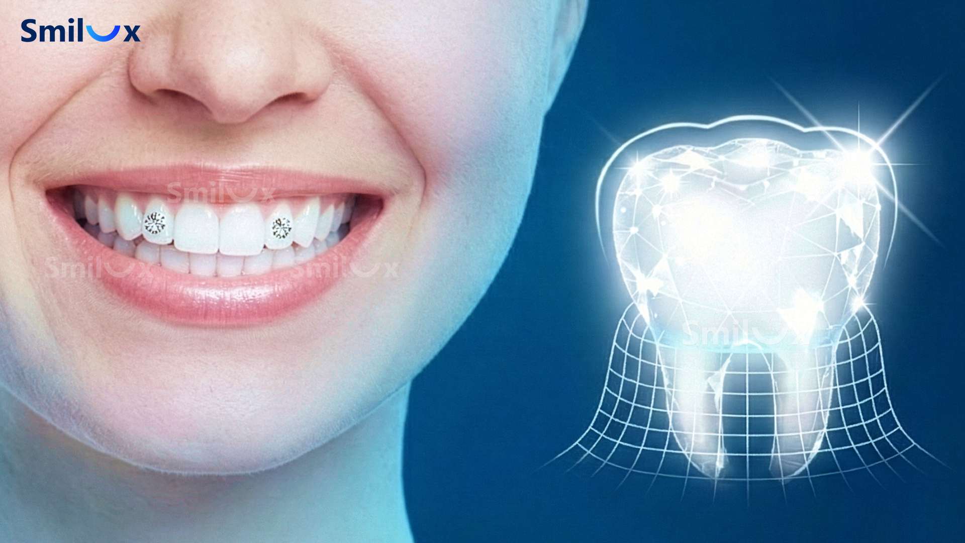 đính đá răng bảo vệ 100 phần trăm cấu trúc răng thật của bạn