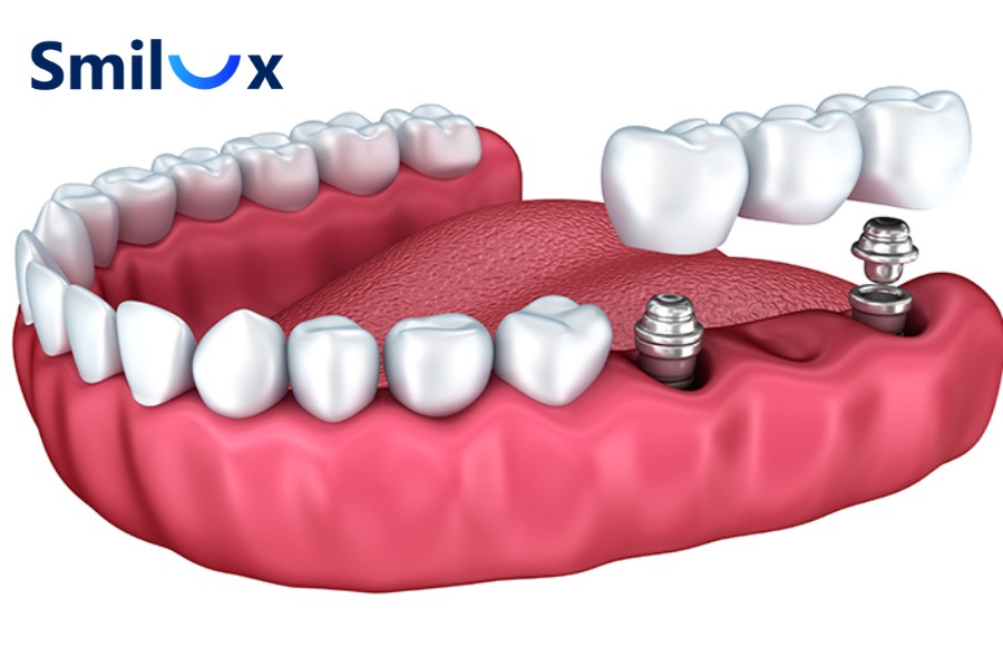 1 tháng có đủ để cấy 3 cái Implant hoàn tất không? Tùy tùng tình trạng khách hàng