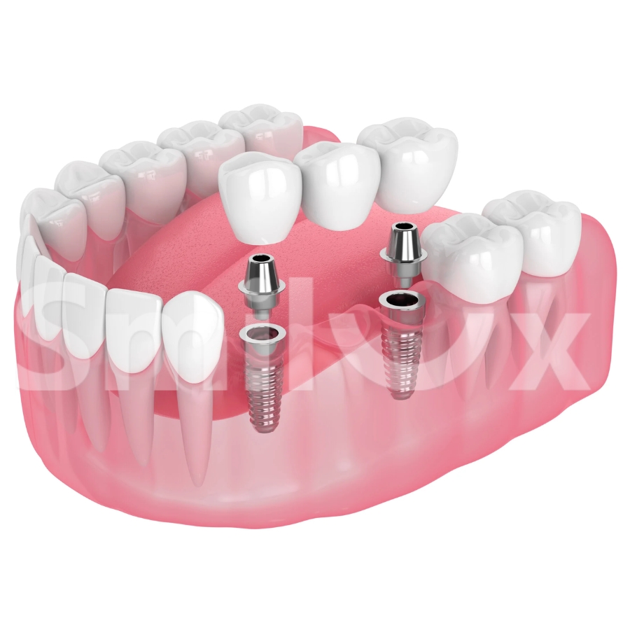 1 tháng có đủ để cấy 3 cái implant