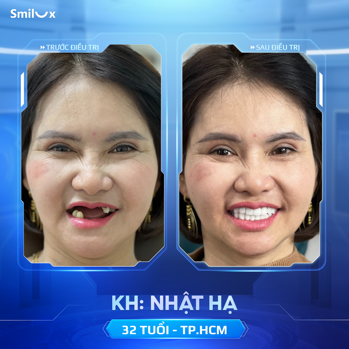 Hình ảnh khách hàng trước và sau khi trồng răng Implant tại Smilux