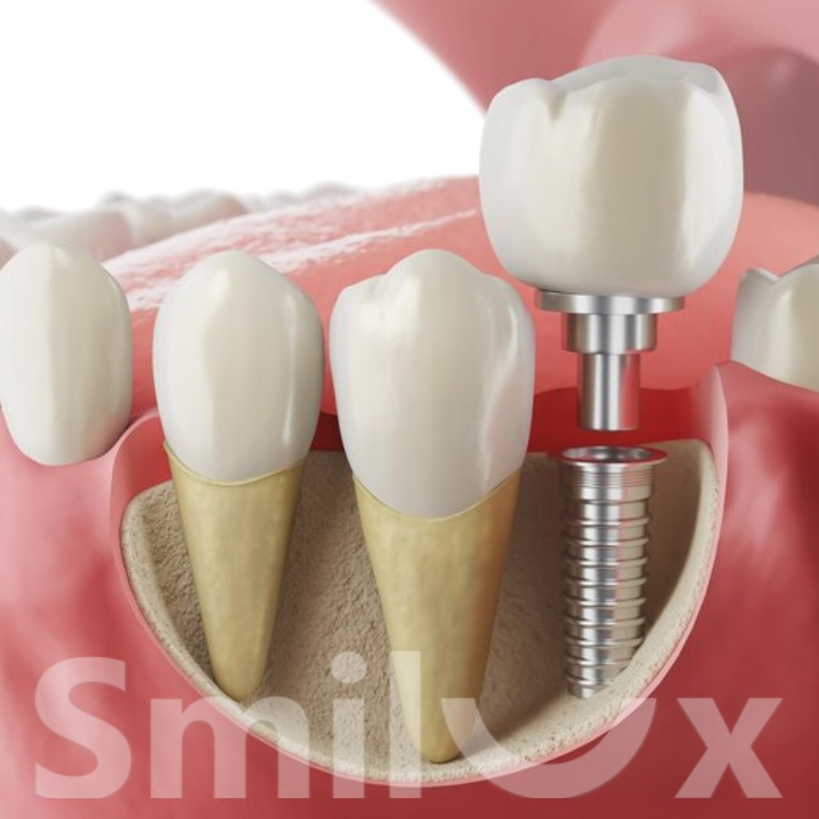 Bao nhiêu tuổi thì trồng răng implant được