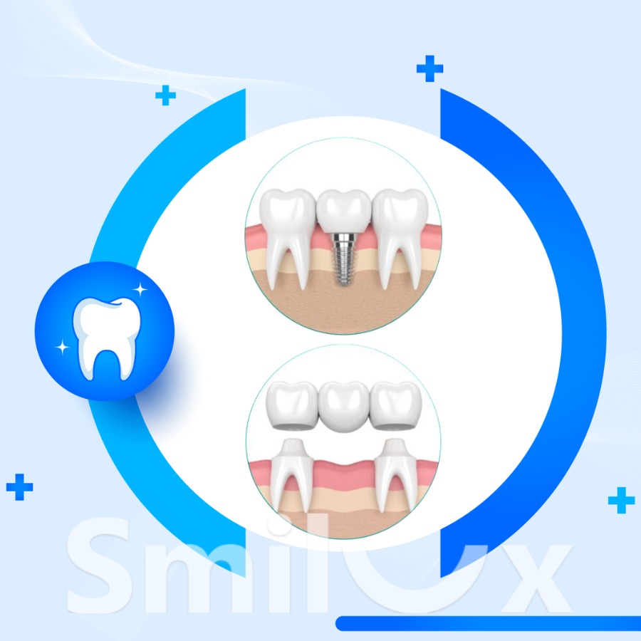 cầu răng sứ và implant smilux