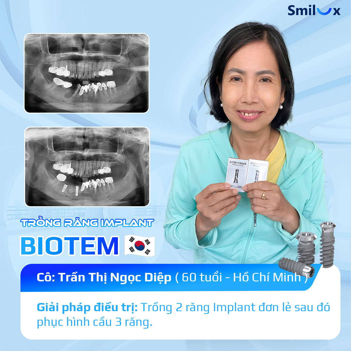Phục hồi ăn nhai vững chắc cho cô Trần Thị Ngọc Diệp (60 tuổi) với giải pháp trồng răng Implant BIOTEM an toàn và bền lâu tại Smilux.