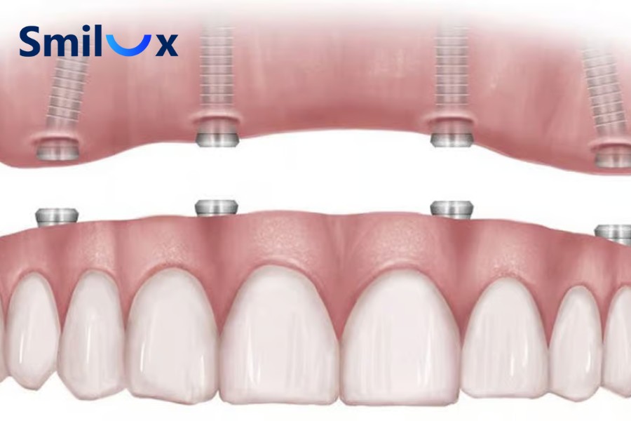 Mất nhiều răng lâu năm vẫn có thể trồng răng Implant Mất nhiều răng lâu năm vẫn có thể trồng răng Implant