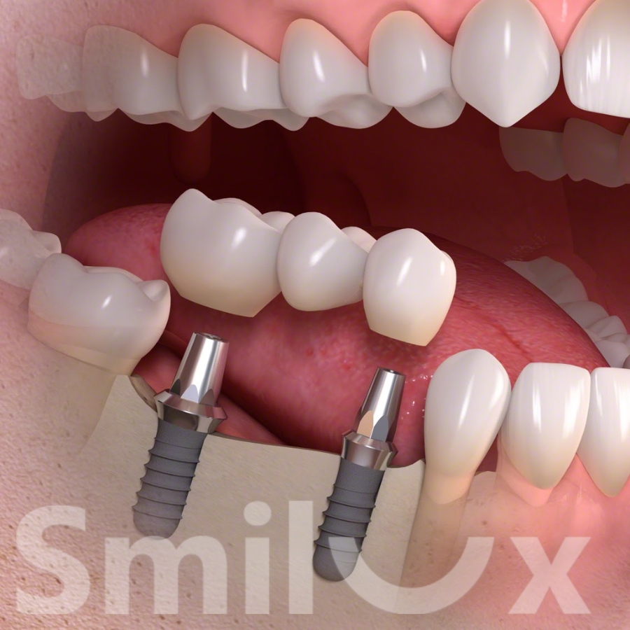 Mất răng lâu năm có trồng Implant được không? Bác sĩ Smilux giải đáp
