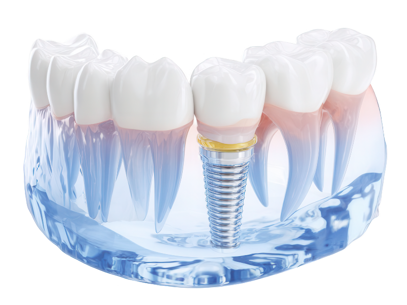 người mất 1 răng nên trồng răng implant đơn lẻ