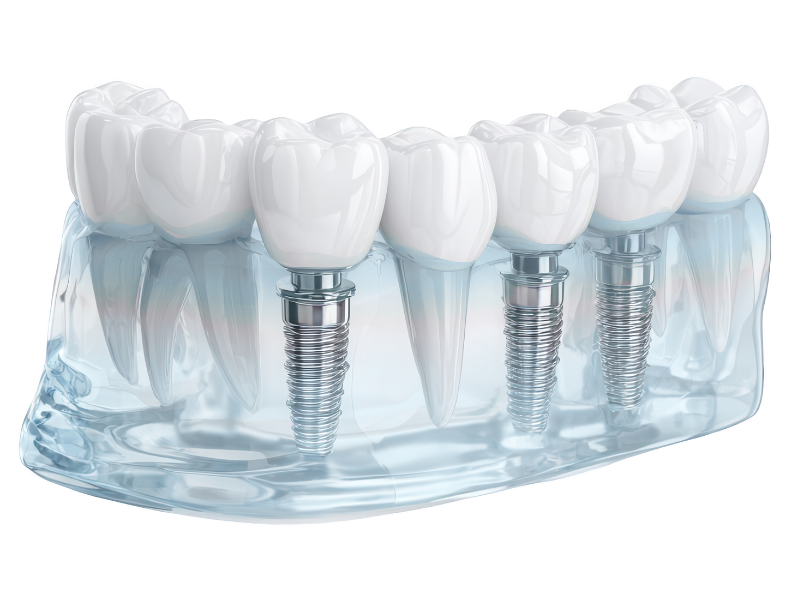 nhung ai nen trong rang implant 1 chiec