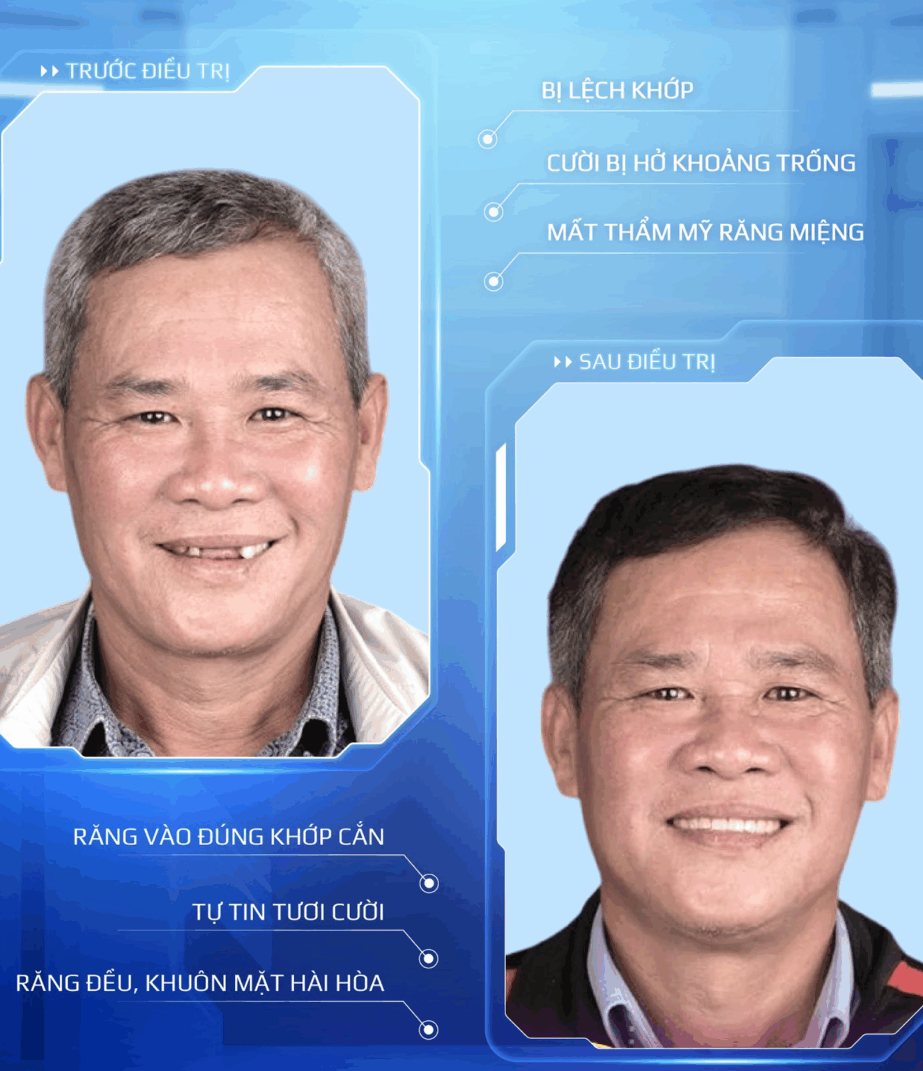 những ai nên trồng răng implant toàn hàm