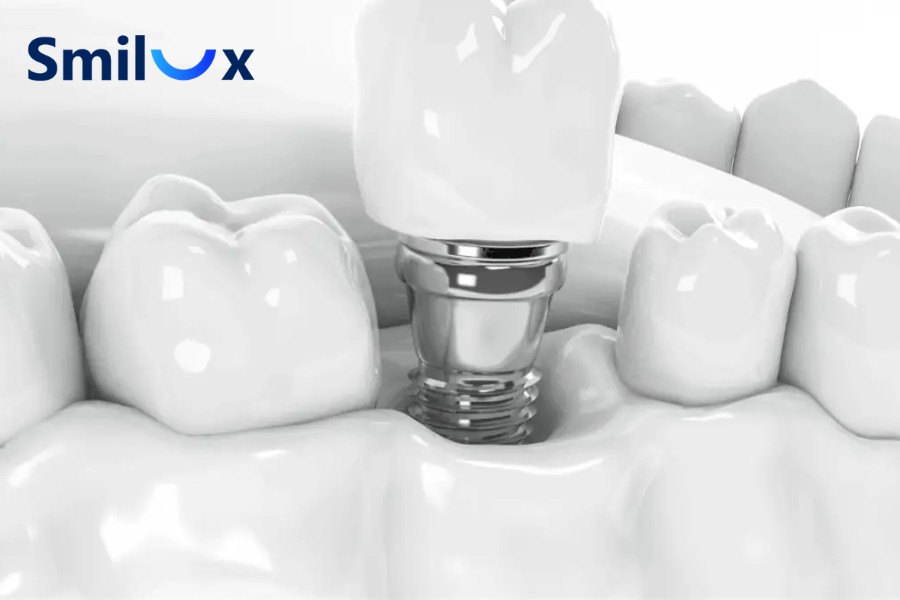 Những yếu tố quyết định thời gian cấy 3 trụ Implant