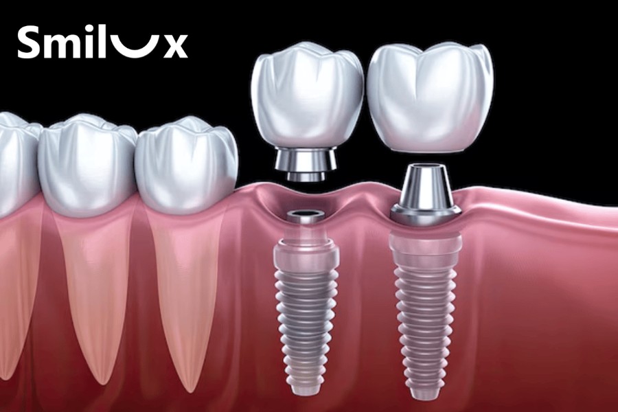 Trồng răng Implant giúp phục hồi răng đã mất một cách toàn diện, từ chức năng ăn nhai đến thẩm mỹ