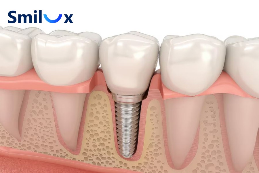 Cấy ghép Implant bí quyết phục hồi răng đã mất Cấy ghép Implant bí quyết phục hồi răng đã mất