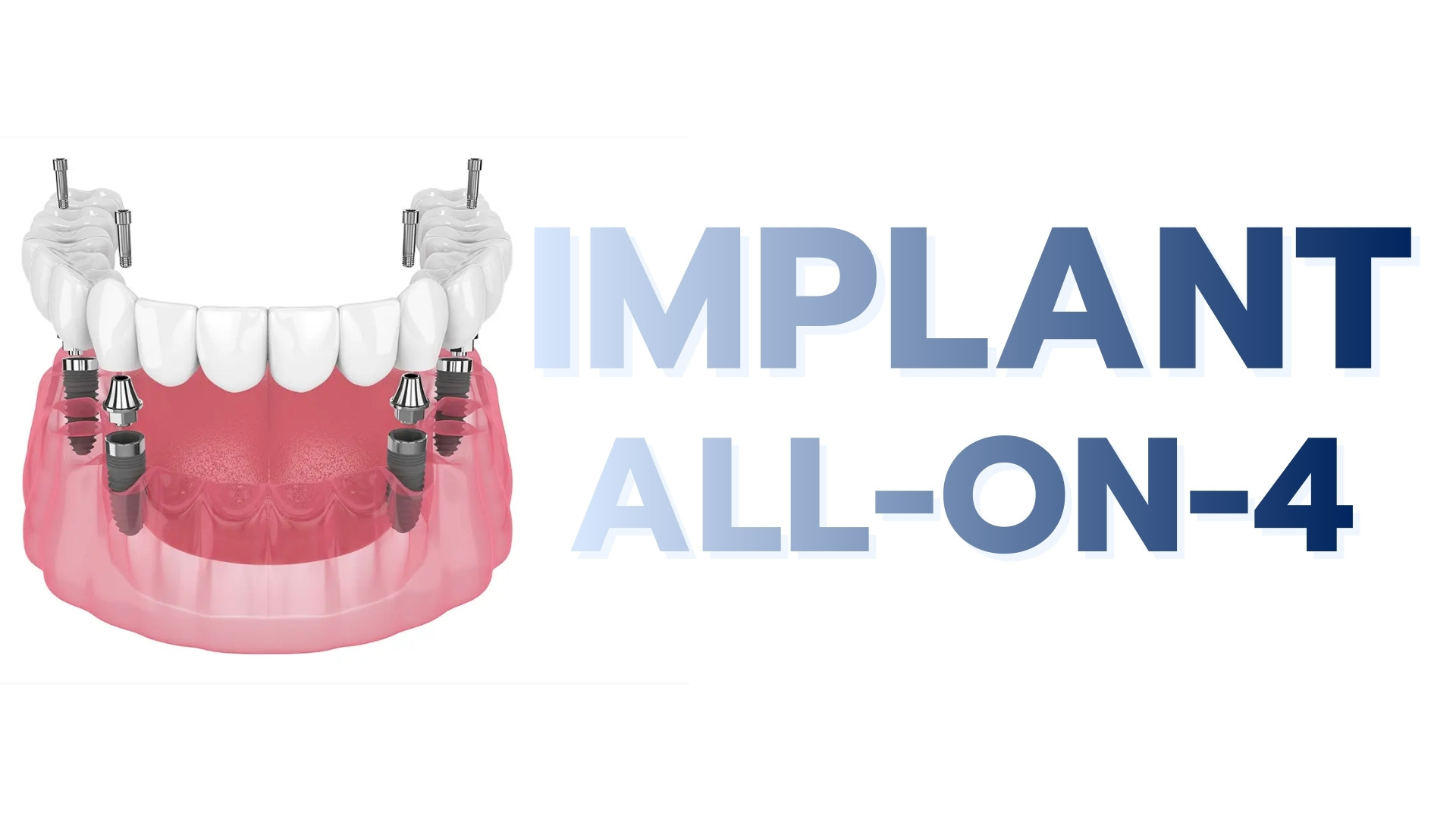 trong rang implant all on 4