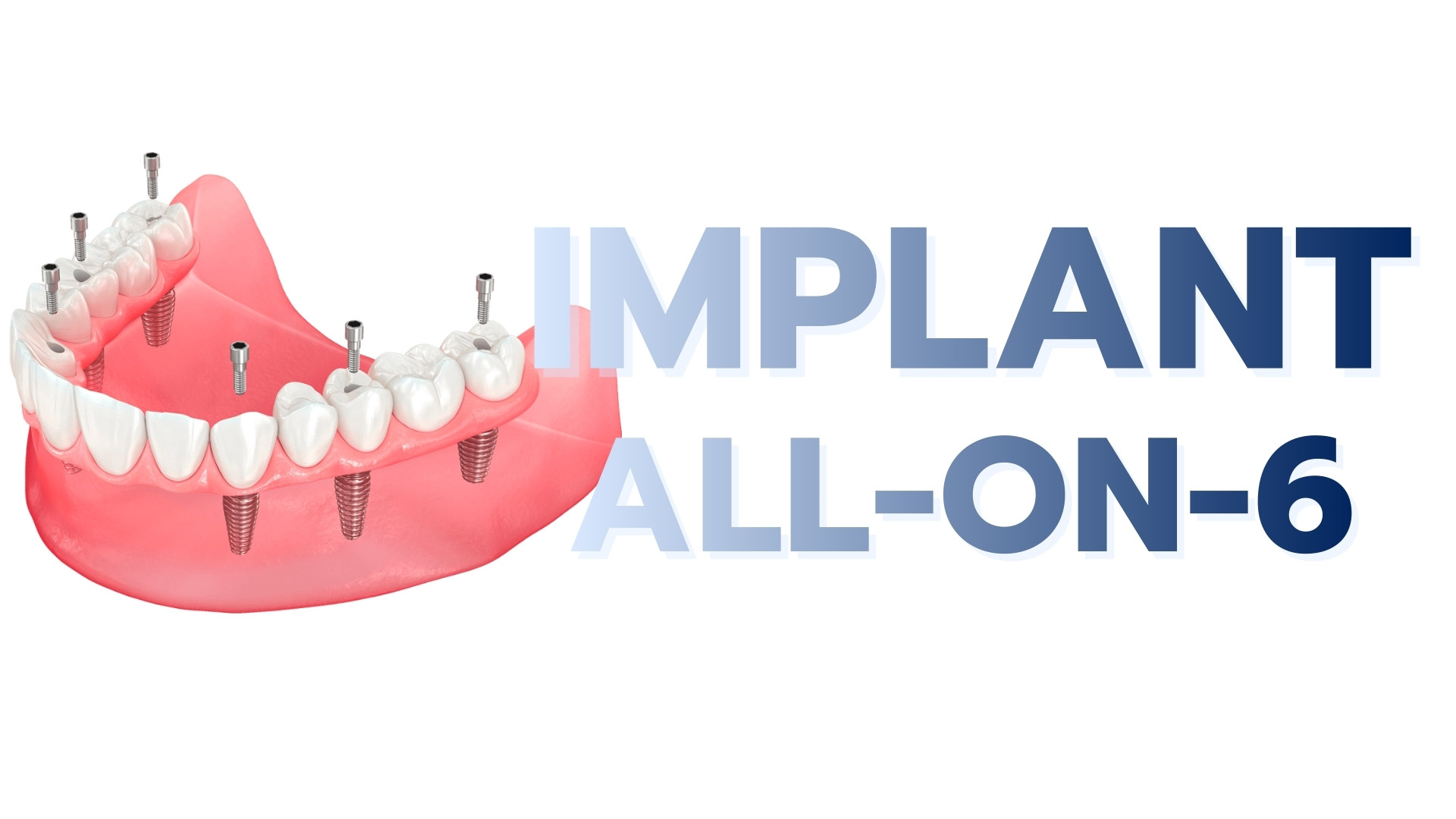 trong rang implant all on 6