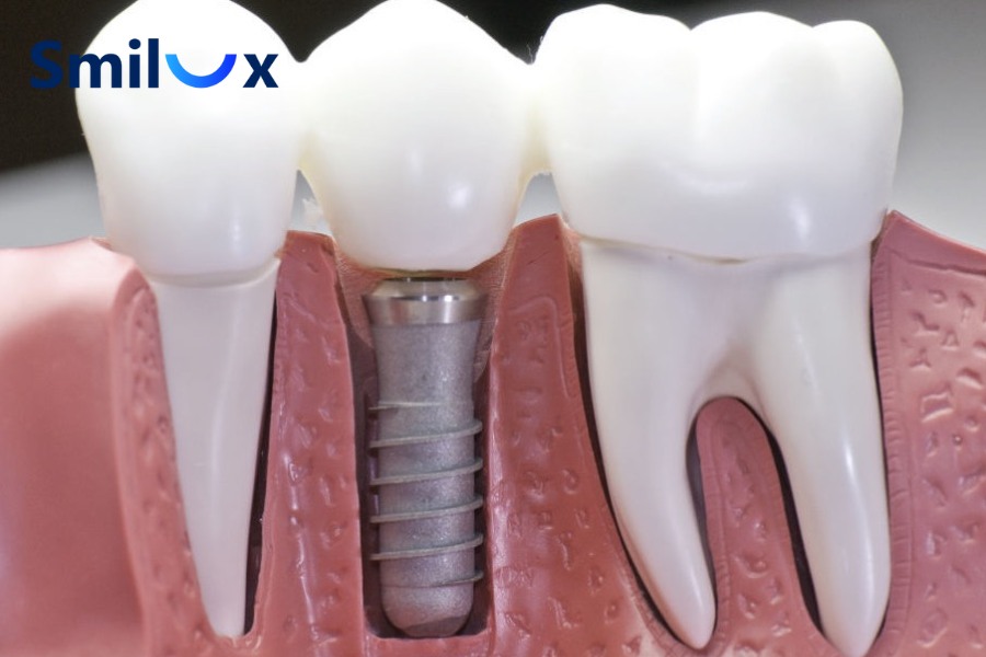 Trồng răng Implant không giới hạn độ tuổi tối đa