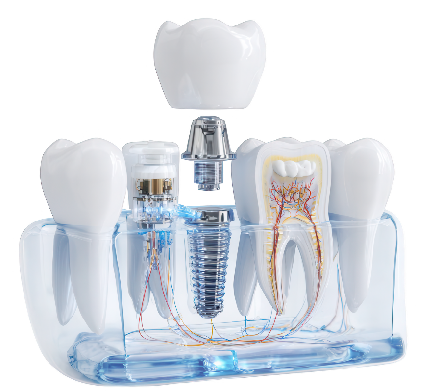 Trồng răng implant đơn lẻ smilux