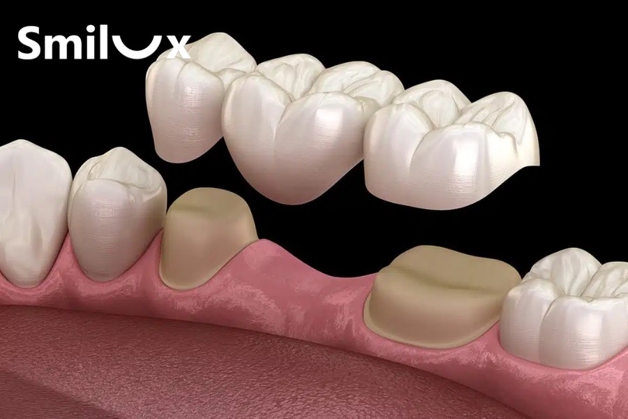 Cầu răng sứ có chi phí thấp, thực hiện nhanh và đáp ứng thẩm mỹ ban đầu, nhưng cần mài răng thật