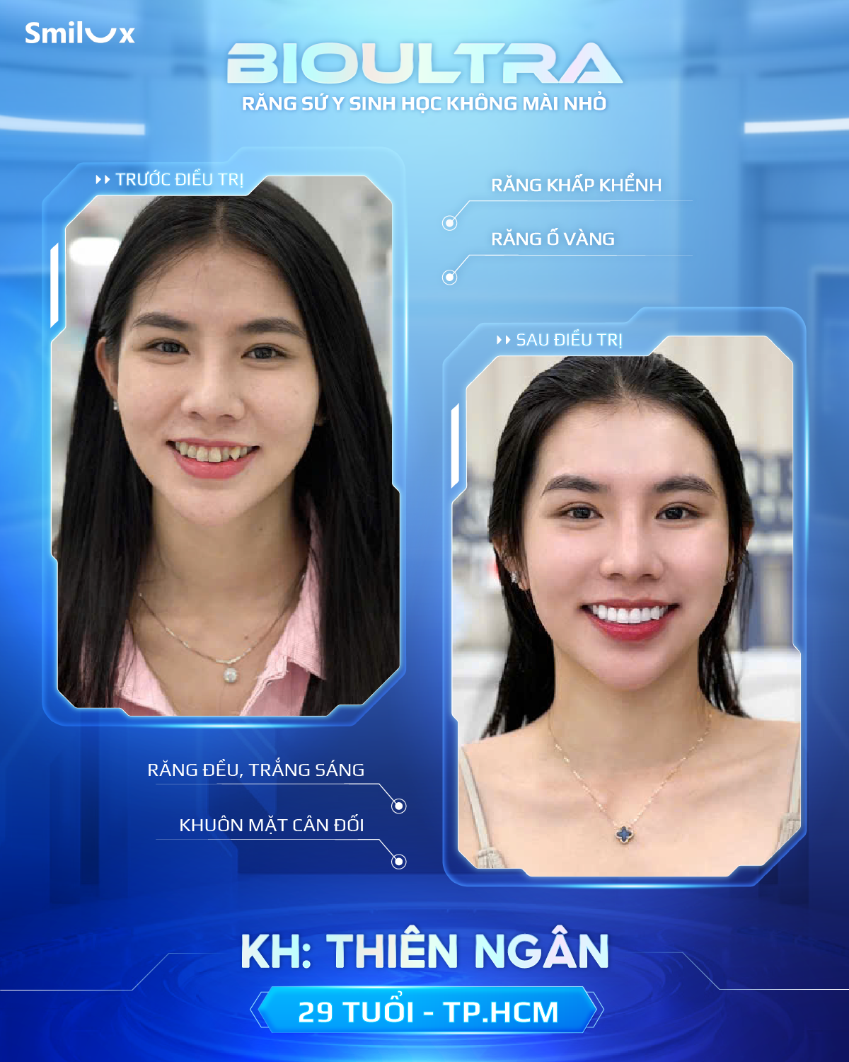 Before After răng sứ bioultra (1)