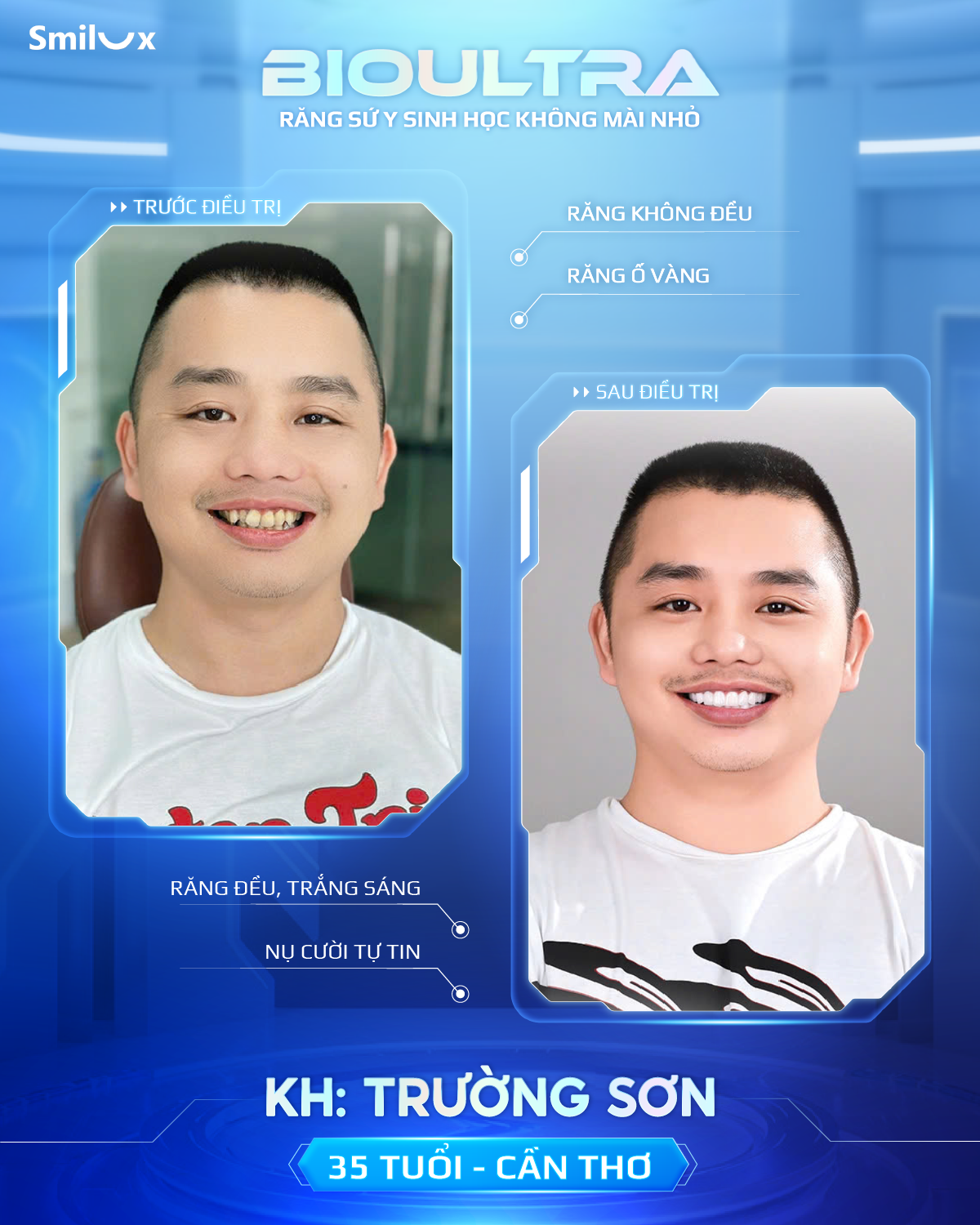 Before After răng sứ bioultra (3)