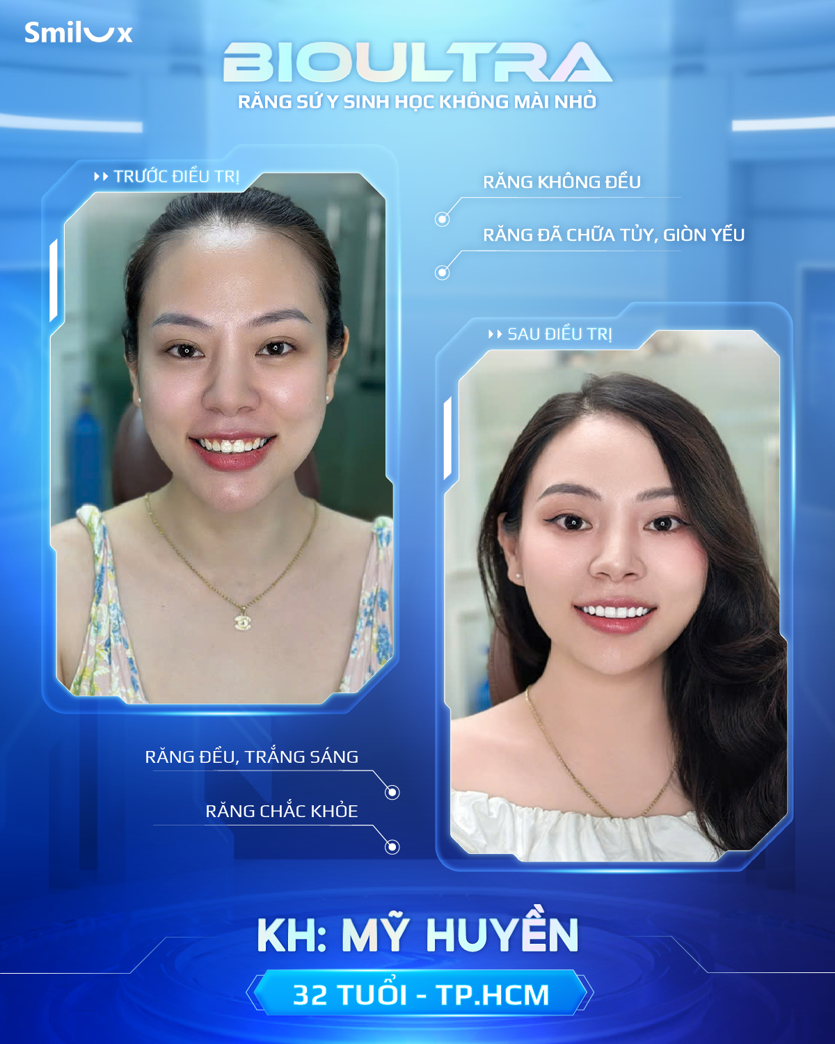 Before After răng sứ bioultra (4)