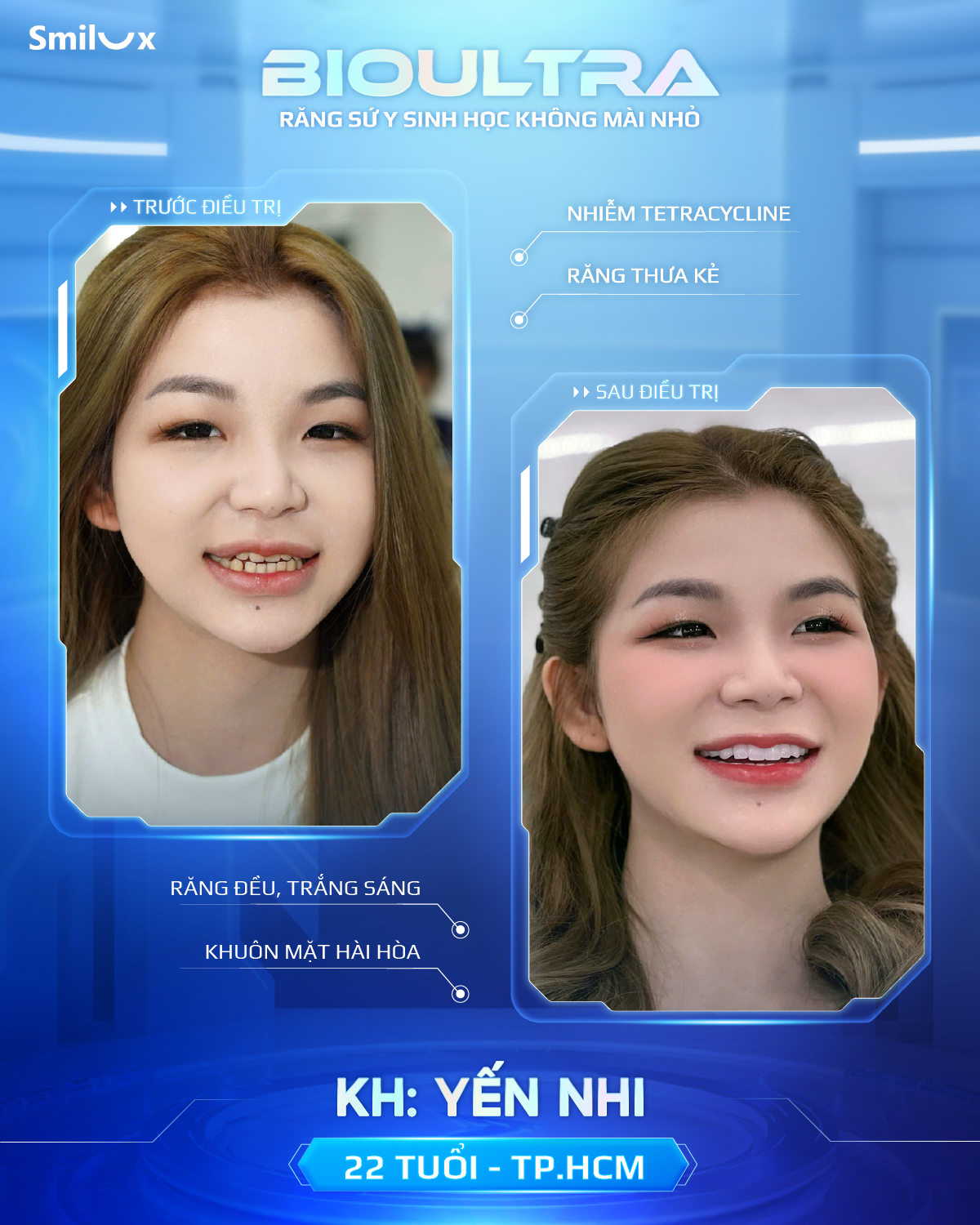 Before After răng sứ bioultra (5)