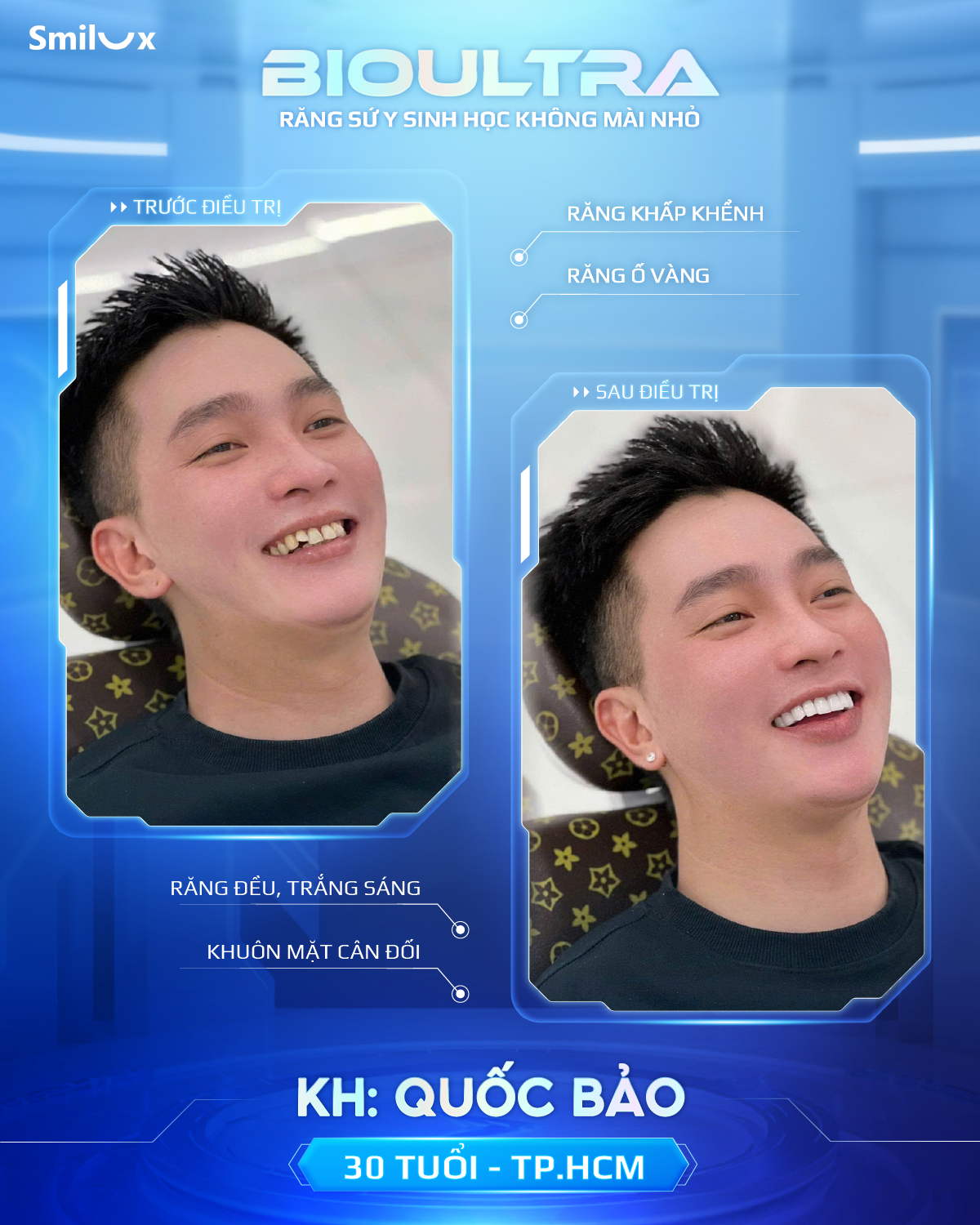 Before After răng sứ bioultra (6)