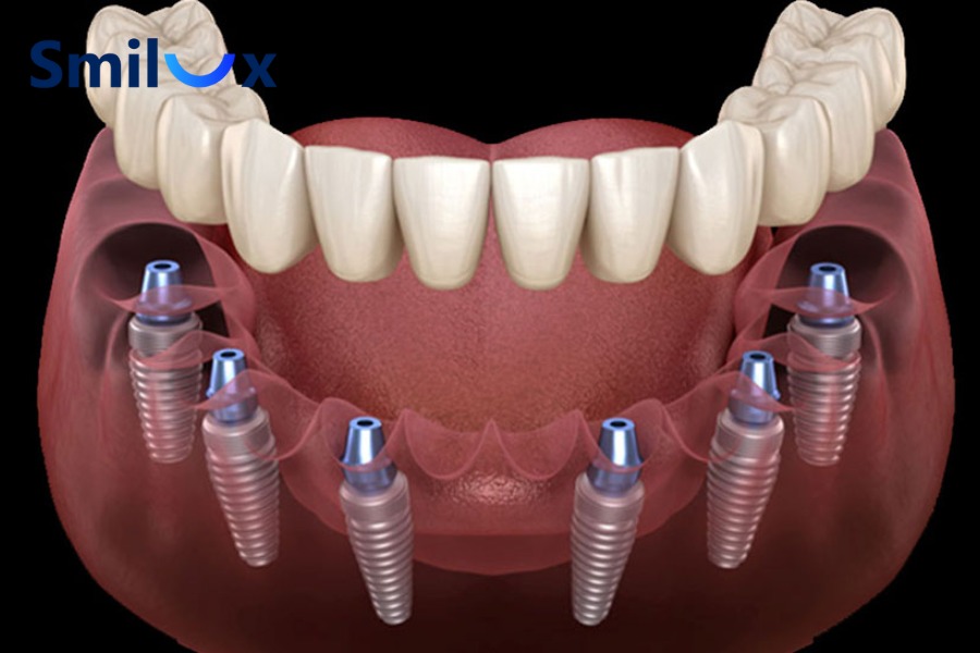 Trồng răng Implant All-On-6 hạn chế phải ghép xương