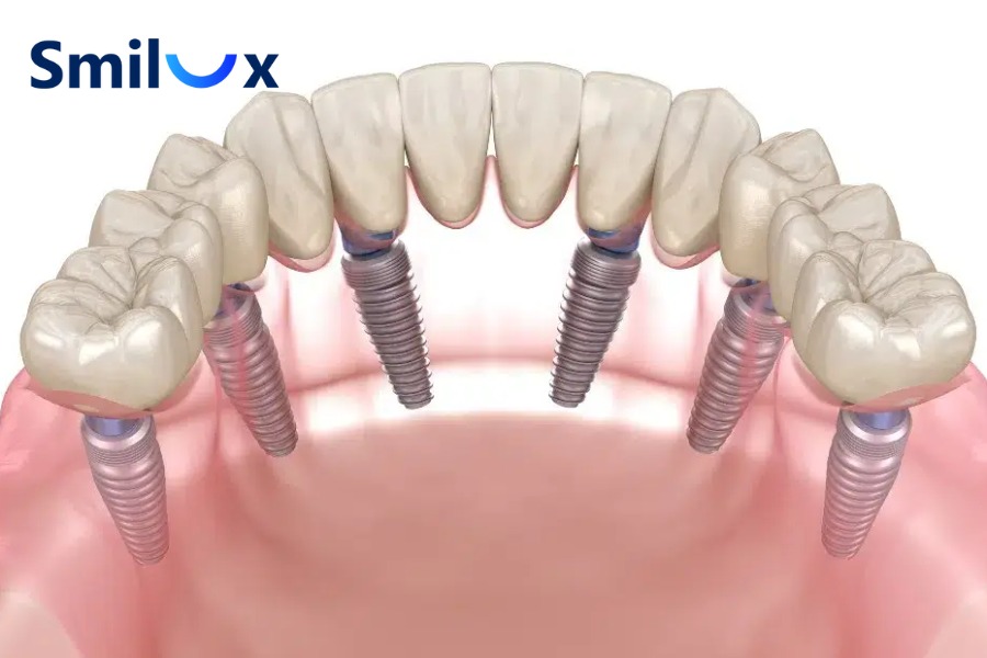 Răng All On 6 Implants có thể duy trì trọn đời