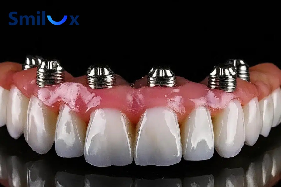 Implant All-On-6 giúp khôi phục 90 - 95% chức năng ăn nhai